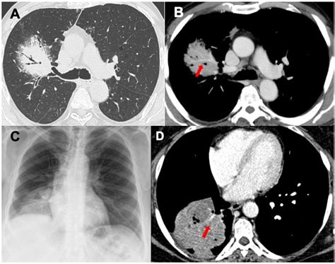 Diagnostics Free Full Text Primary Lymphoproliferative Lung