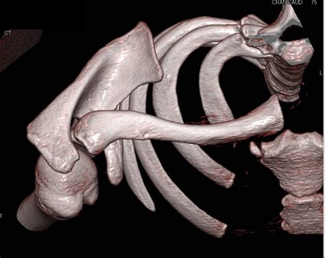 Posterior Dislocation Of The Right Clavicle At Sternoclavicular Joint