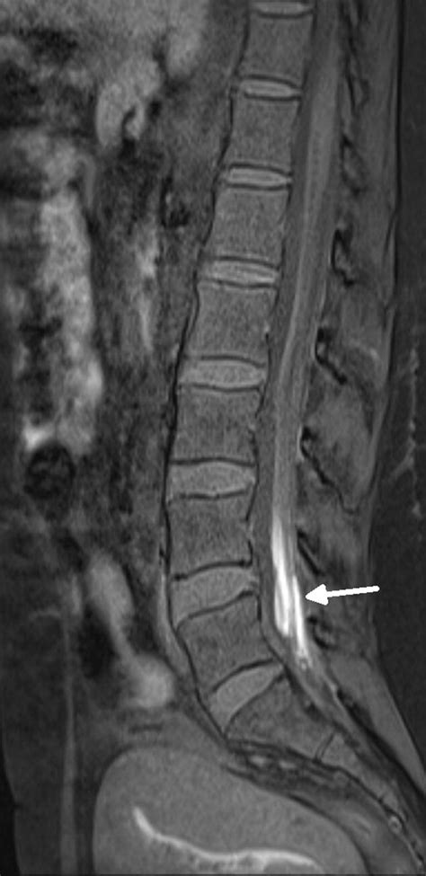 Chronic Adhesive Arachnoiditis After Repeat Epidural Blood Patch