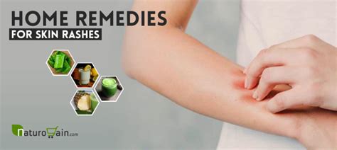 10 Simple And Best Home Remedies For Skin Rashes