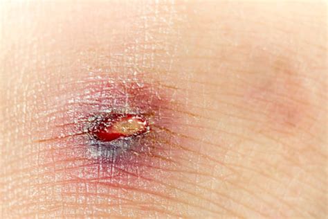 Open Wound Healing Process Stock Photos Pictures And Royalty Free Images