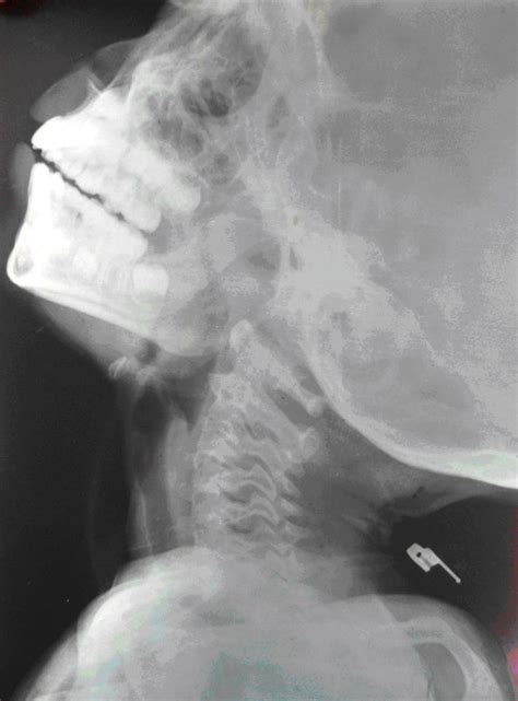 X Ray Of The Nasopharynx Showing Hypertrophied Nasopharyngeal Tonsils