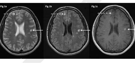 Figure 1 From Multiple Sclerosis Update Use Of Mri For Early Diagnosis