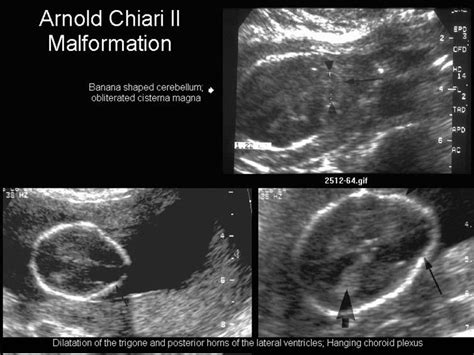 Arnold Chiari Type Ii Malformation Diagnostic Medical Sonography My