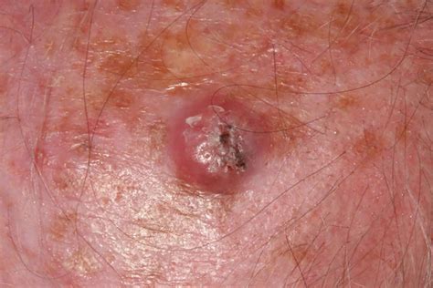 How To Visually Identify The Various Forms Of Skin Cancer Pictures