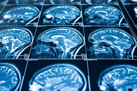 Adhd Brain Scan How Brain Scans May Change The Adhd Diagnoses