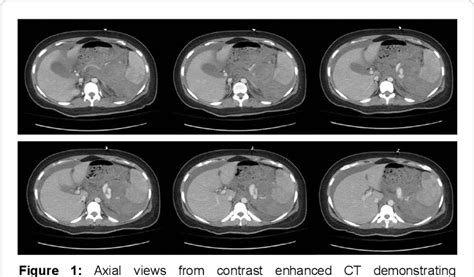 Figure 1 From Management Of Spontaneously Ruptured Splenic Artery