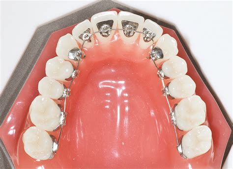 Internal Lingual Braces Melbourne Core Dental