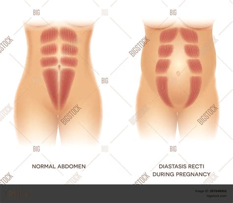 Diastasis recti is a condition where the muscles separate into a right and left side of the abdomen. Diastasis Recti Vector & Photo (Free Trial) | Bigstock