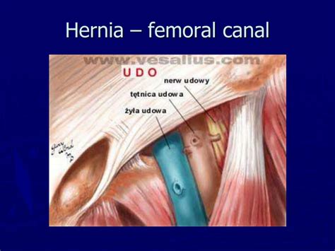 Ppt Hernia Powerpoint Presentation Free Download Id2306551