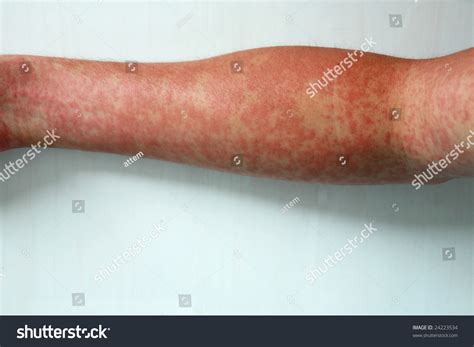 Typical Macular Rash Forearm This Could Stock Photo 24223534 Shutterstock