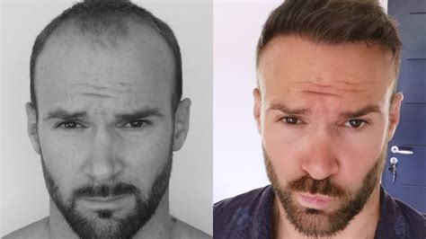 Top 120 Temple Hair Transplant Before After Polarrunningexpeditions