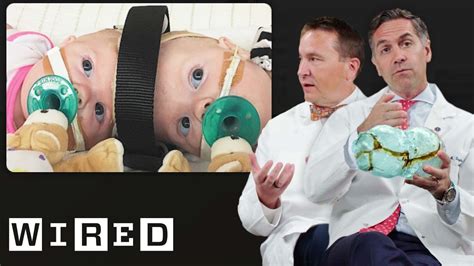 Surgeons Break Down Separating Conjoined Twins Wired Youtube