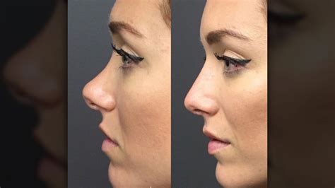 la técnica de las celebrities para operarse la nariz sin pasar por el quirófano infobae