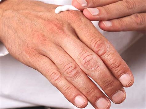 How long does eczema itch last? How to stop itching skin at night home remedies ...