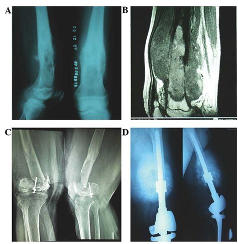 Late Post‑operative Recurrent Osteosarcoma Three Case Reports With A