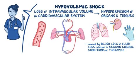 Shock Hypovolemic Nursing Osmosis Video Library