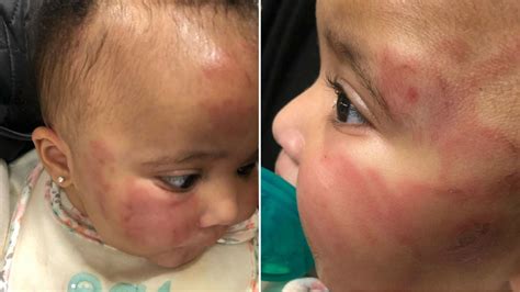 6 Month Old Infant Comes Home Bruised After Bitten Falling Down Stairs