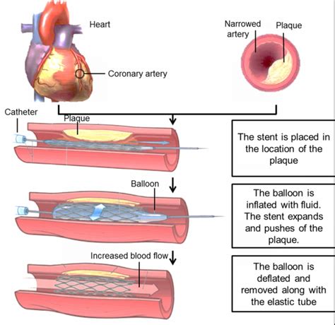 Angioplasty With Stent Implantation Procedure Schematic Illustration