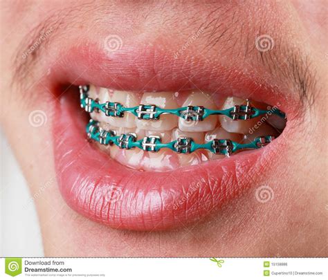 You can straighten your teeth at any time, no matter how. Braces stock photo. Image of white, crooked, cosmetic ...