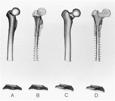 Three Dimensional Reconstructed Model Of A Class Iv Femur The
