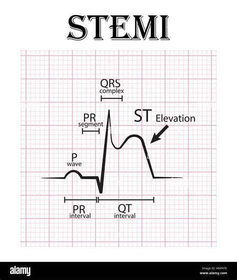 Ecg De Infarto De Miocardio Con Elevaci N Del St Stemi Y Detalle De