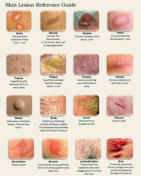 Dermatology Lesions Chart