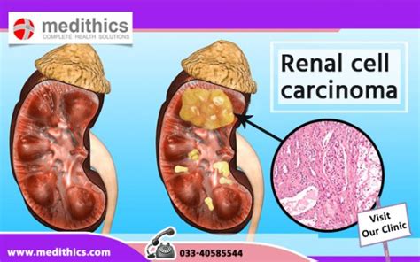 Renal Cell Carcinoma Symptoms Causes Diagnosis Treatment