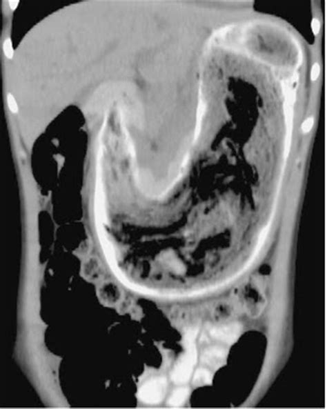 Radiological features of Bezoar - Radiology Imaging
