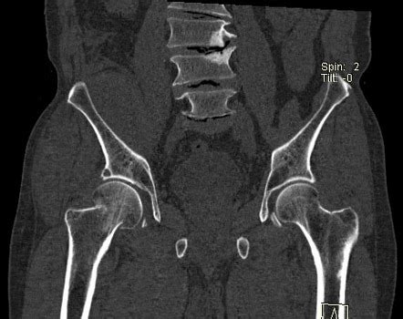 Impacted Femoral Neck Fracture Radiology Case Radiopaedia Org