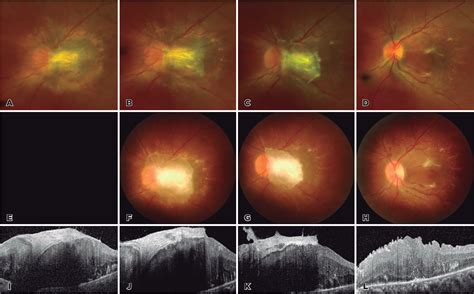 Scielo Brasil A Case Of Combined Hamartoma Of The Retina And