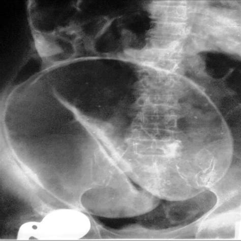 The sigmoid volvulus, showing the dilated and twisted sigmoid colon ...