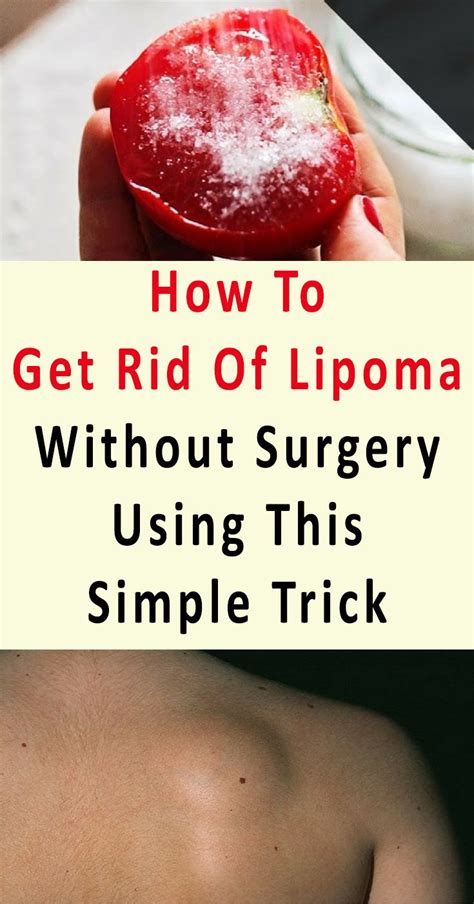 Health Care Using This Simple Remedy How To Get Rid Of Lipoma Without