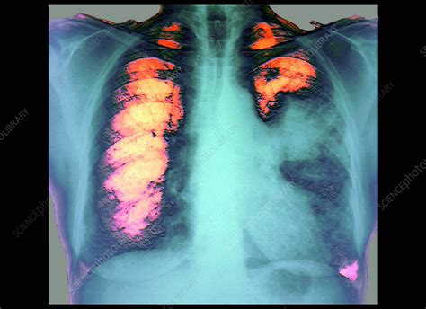 Lung Cancer X Ray Stock Image M1340411 Science Photo Library