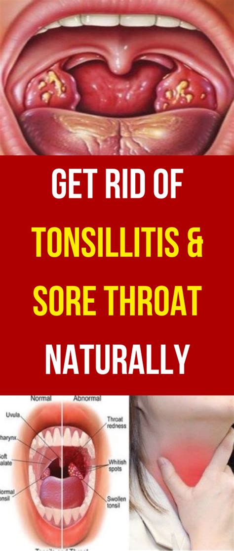 Get Rid Of Tonsillitis And Sore Throat Naturally