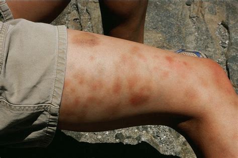Leg Bruises On An Anonymous Friend After Climbing Steck Salathe