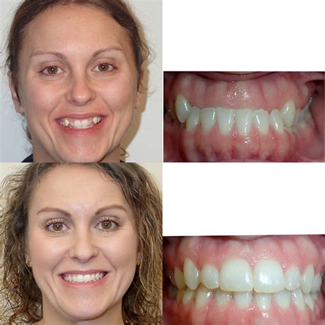 Adult Braces Before And After