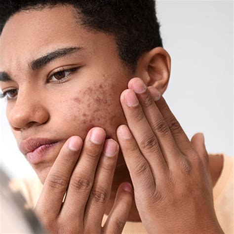 The 6 Different Types Of Acne And How To Treat Them Skinmart