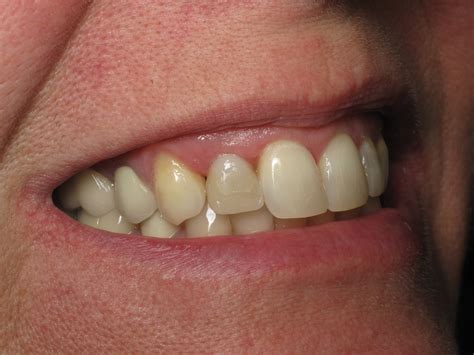 Shaping And Forming Gum Around Front Teeth Dental Implants