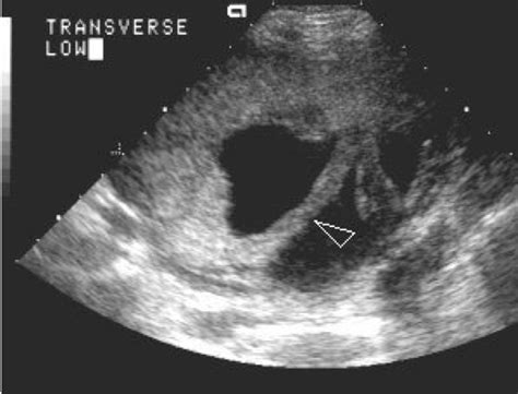 Recognizing Intra Amniotic Band Like Structures On Obstetric Ultrasound