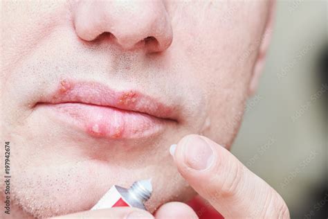 Herpes Simplex On Lips Images