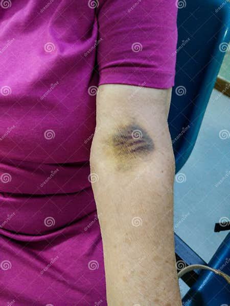 Medicine Large Hematoma On The Left Arm Of An Elderly Woman Caused By