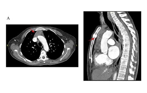 Thymic Hyperplasia In Severe Graves Hyperthyroidism A Case From The