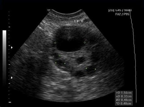 Dominant Graafian Follicle What Phase Is This Ov In Sonography