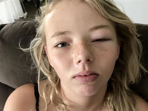 Kmart Eye Mask ‘blinds Teen With Allergic Reaction The Advertiser