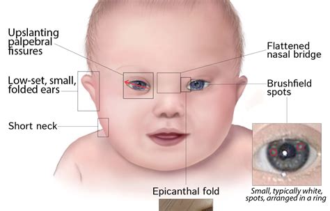 Epicanthal Folds Down Syndrome News Word