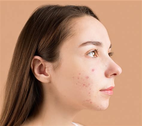 Does Stress Cause Acne Yes And Here Is How You Can Start Treating It Naturally Whole Systems