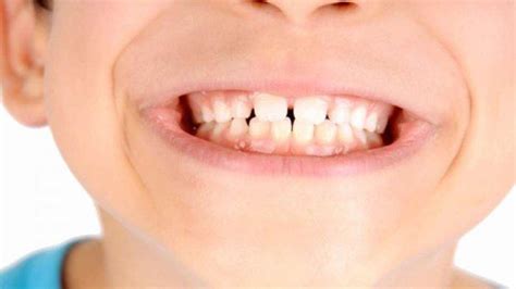 Kebiasaan Menggertakkan Gigi Karena Faktor Bertambahnya Usia Atau