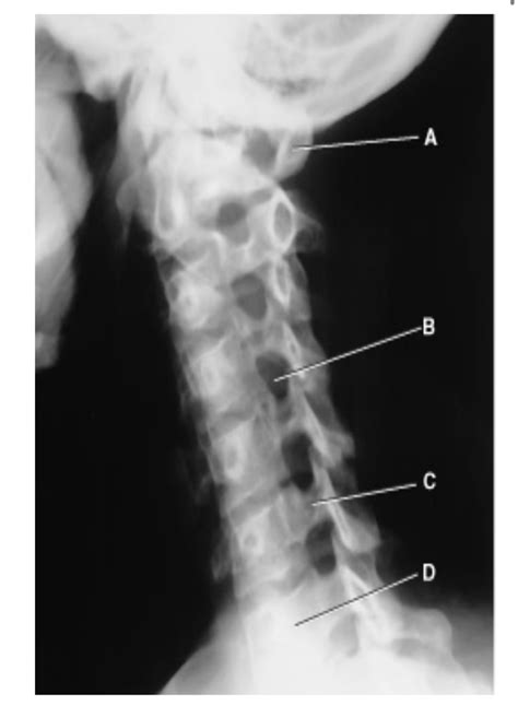 Ap Oblique C Spine Diagram Quizlet