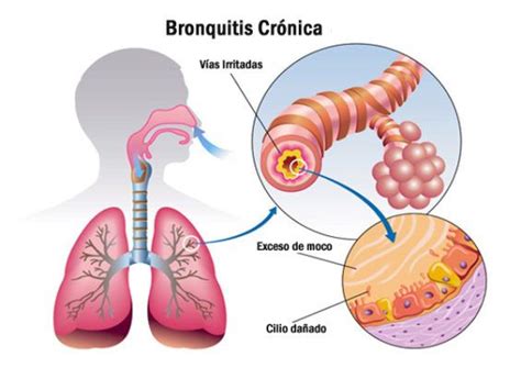 Qu Es La Bronquitis Cr Nica